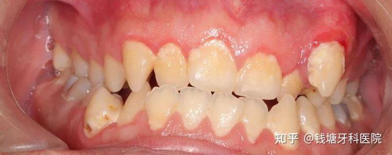 瑞泰口腔正畸效果如何？真实体验值得信赖吗？-图3