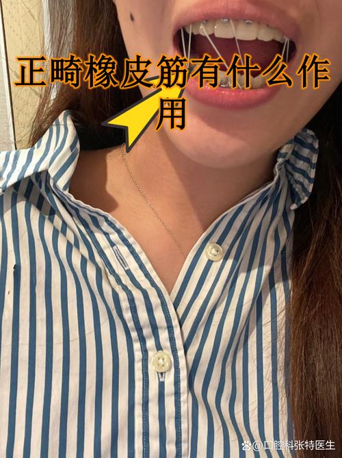 正畸橡皮链磨嘴巴-图2