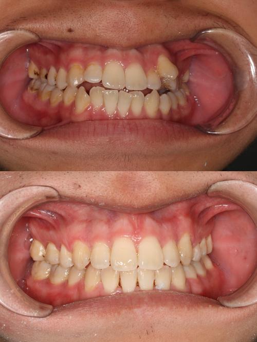 正畸橡皮链磨嘴巴-图3