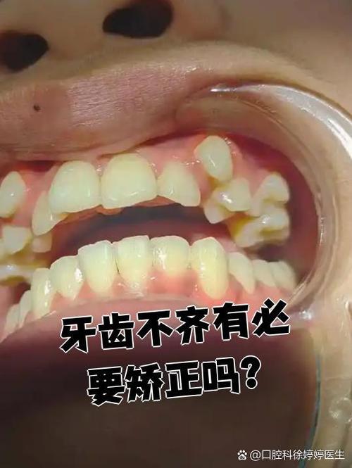 口腔正畸如何有效矫正牙列不齐？-图3