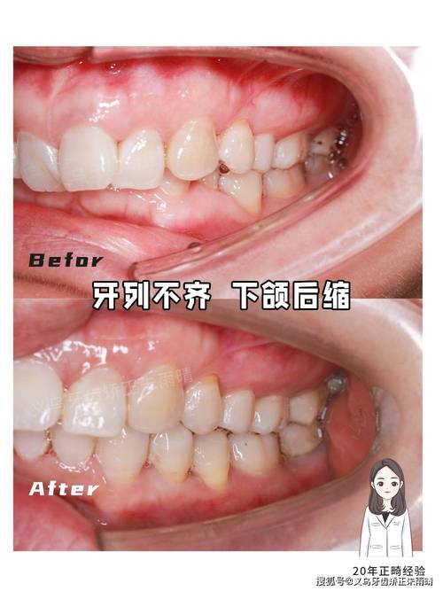 下颌后缩正畸案例，矫正方法有哪些？效果如何？关键点是什么？-图2