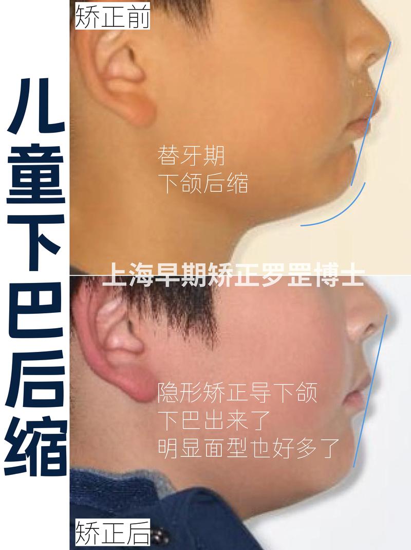 下颌后缩正畸案例，矫正方法有哪些？效果如何？关键点是什么？-图3
