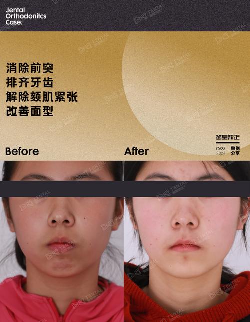 骨突正畸完美病例,效果真的无可挑剔吗?-图1 骨突正畸完美病例,效果真的无可挑剔吗?-图1