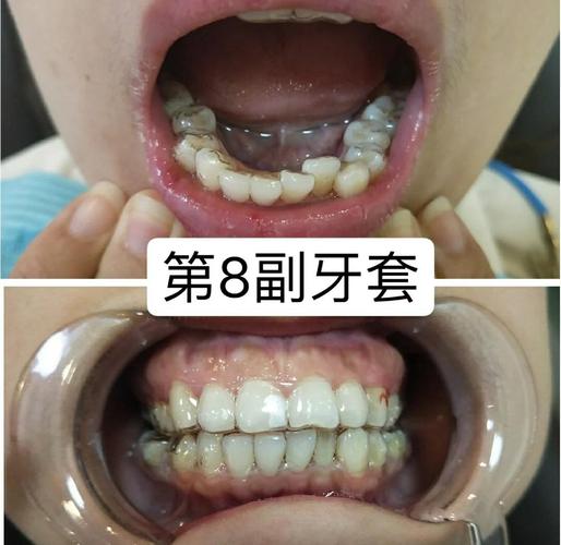 正畸N年后大牙缝，是矫正问题还是其他原因？-图1