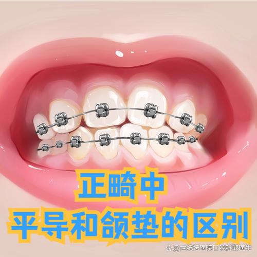 正畸垫咬合用什么材料？不同类型如何选择更合适？-图3