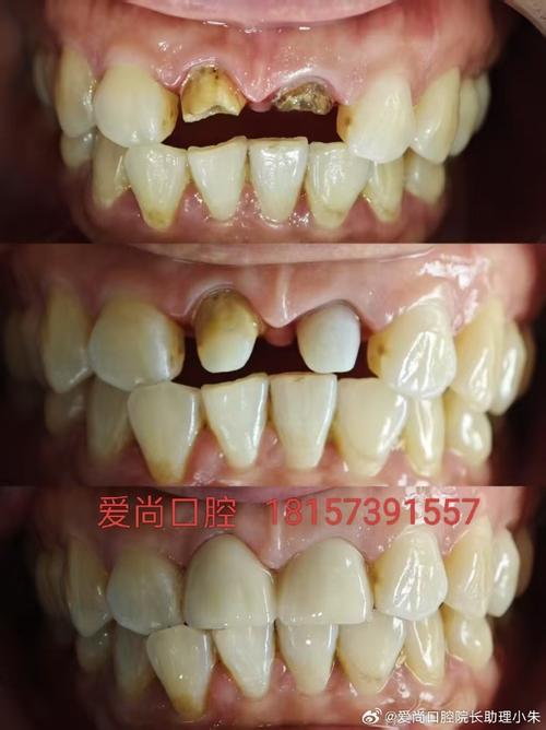 冠修复后正畸治疗-图2 冠修复后正畸治疗-图2