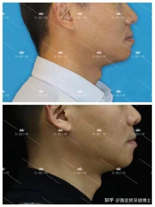 正畸反颌矫正病历，矫正效果与过程如何体现？-图3