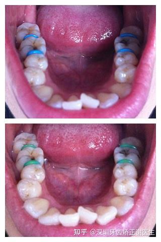 正畸分牙过程是怎样的？为何分牙是矫正的关键一步？-图3