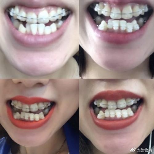 上牙外凸正畸能矫正吗？原因何在？-图3