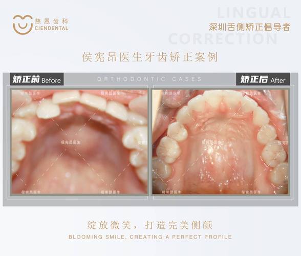 正畸中拱形效应如何实现牙齿精准排列与移动？-图2