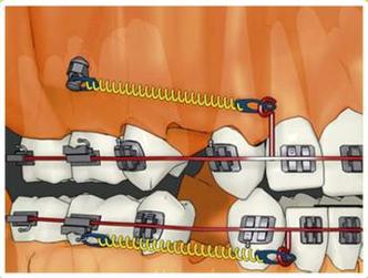 正畸五种常用支抗-图3 正畸五种常用支抗-图3