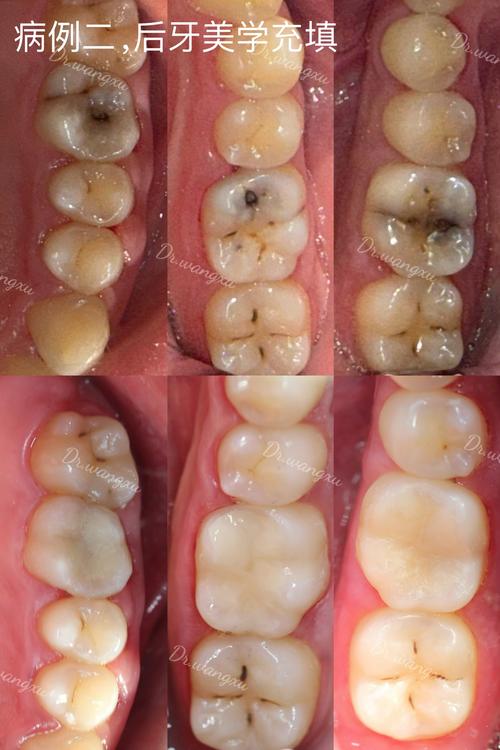 正畸期间能补牙吗？矫正中补牙有影响吗？-图3