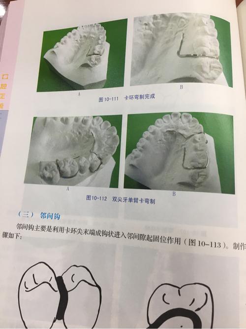 正畸单臂卡环弯制-图2