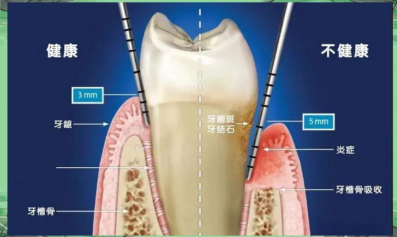 正畸前为何必须先做牙周治疗？-图3