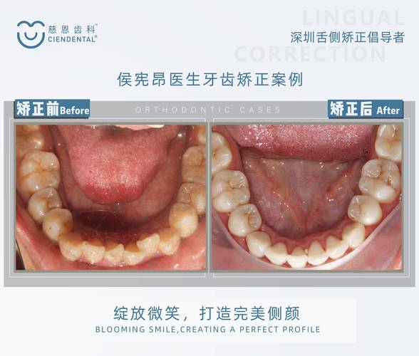 舌侧隐形正畸的隐形矫正原理是什么？如何实现精准移动？-图2