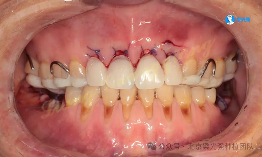 正畸治疗中创伤牙合的成因有哪些？危害是什么？如何应对？-图1