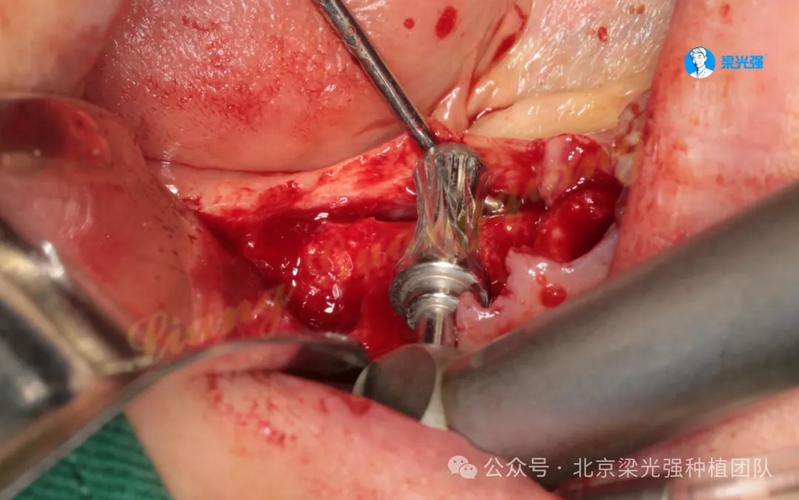 正畸治疗中创伤牙合的成因有哪些？危害是什么？如何应对？-图2