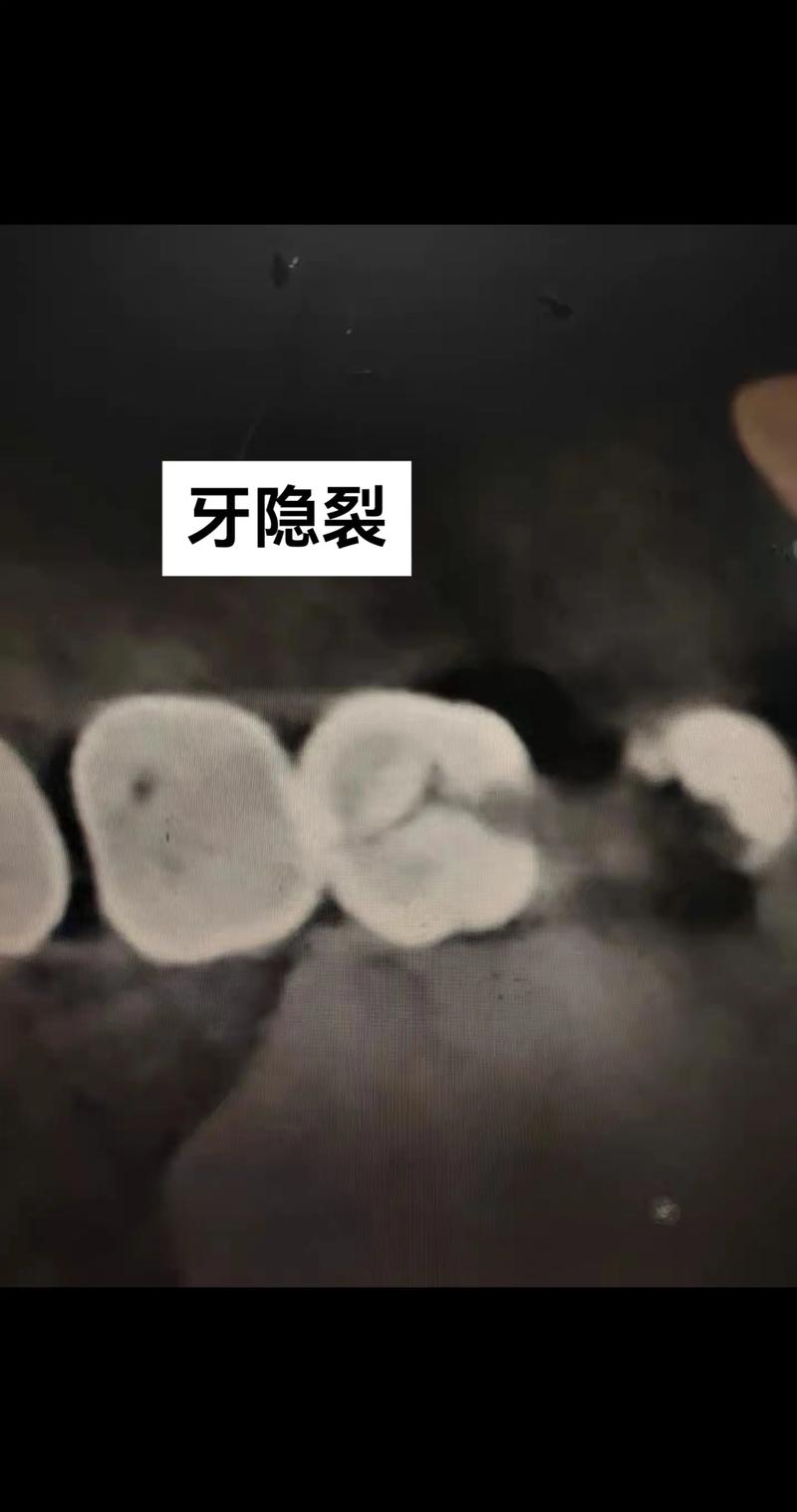 牙隐裂能正畸吗?正畸会加重隐裂风险吗?-图2 牙隐裂能正畸吗?正畸会加重隐裂风险吗?-图2