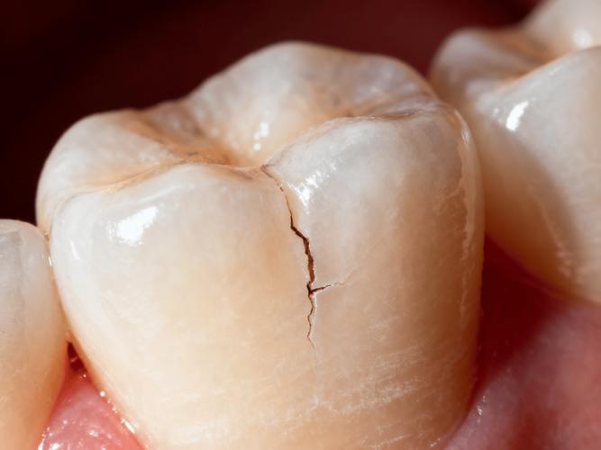 牙隐裂能正畸吗?正畸会加重隐裂风险吗?-图3 牙隐裂能正畸吗?正畸会加重隐裂风险吗?-图3