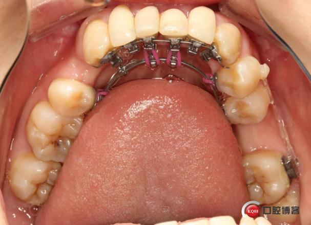 中日医院舌侧正畸效果如何？适合哪些人群？-图3