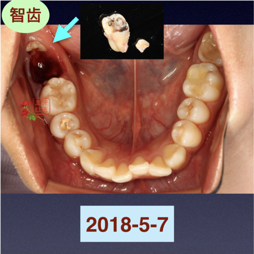 用智齿的位置正畸-图2