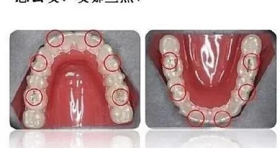 正畸胶边缘发黑是何原因？如何有效处理？-图1
