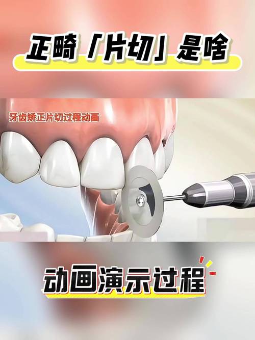 正畸期间补侧切牙可行吗？时机和材料选择要注意什么？-图1