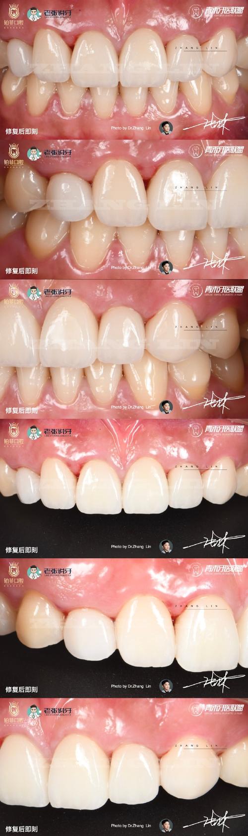 正畸期间补侧切牙可行吗？时机和材料选择要注意什么？-图2