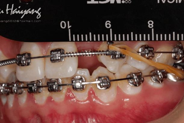 正畸期间补侧切牙可行吗？时机和材料选择要注意什么？-图3