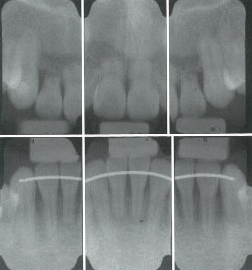 正畸中牙根吸收是怎么回事？有何影响与应对方法？-图2