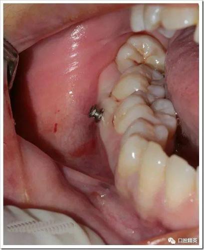 正畸种植钉的视频-图3