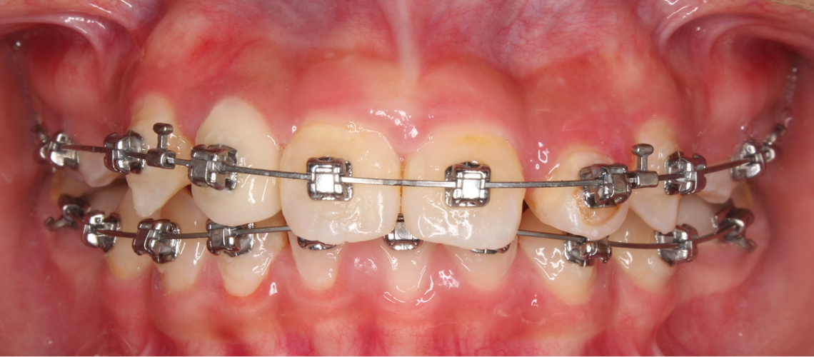 正畸辅弓固定方法-图1