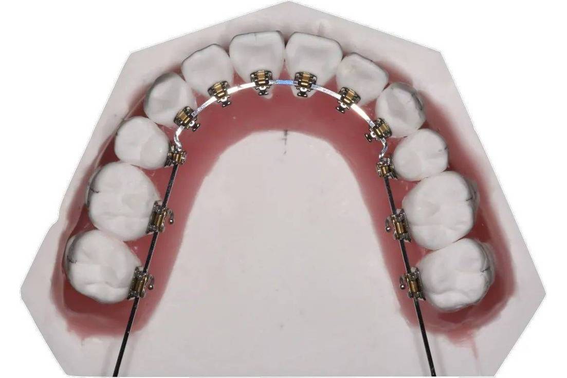 正畸辅弓固定方法-图2