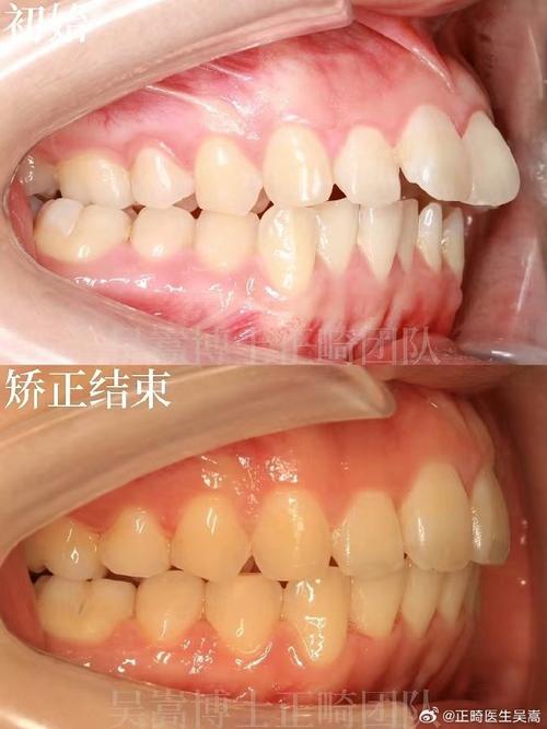 下颌骨矫正后正畸，作用与必要性是什么？-图3