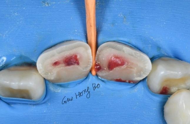 正畸陶瓷牙托脱落-图3