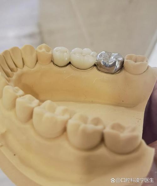 正畸陶瓷牙托脱落-图2