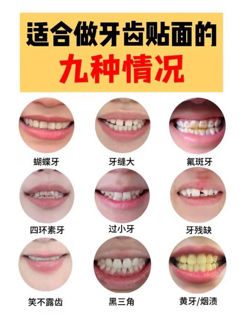 先正畸还是先贴面？顺序决定牙齿美观效果？-图1