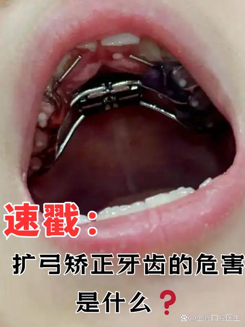 正畸牙弓多久整平-图3