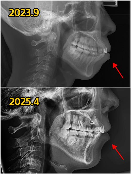 骨性正畸前后拍片-图2