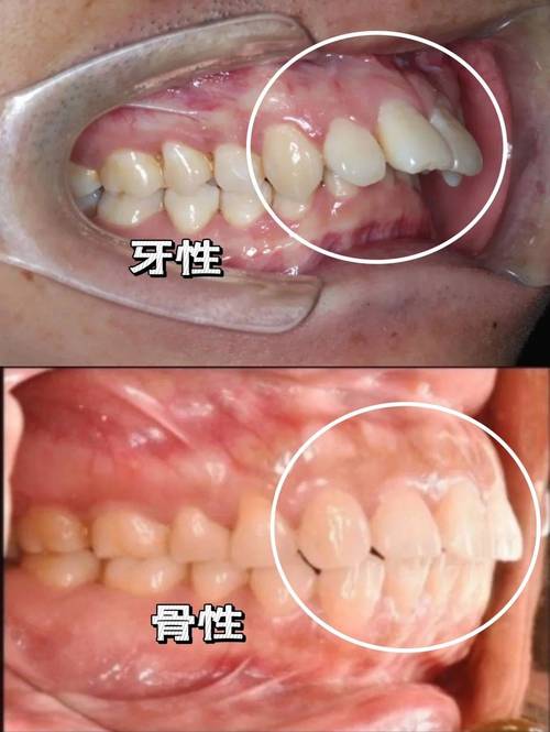 骨性正畸前后拍片-图3