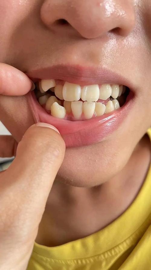 虎牙缺失影响美观？口腔正畸如何矫正？-图3