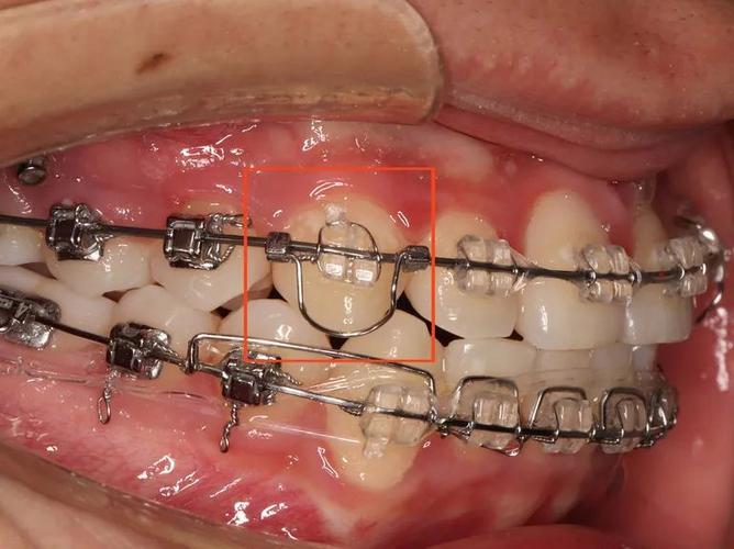 正畸压低辅弓应用-图1