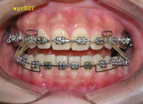 正畸压低辅弓应用-图2