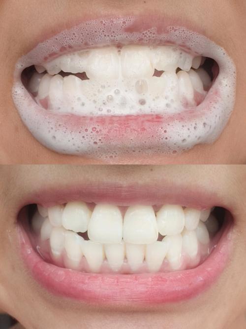 正畸牙根部位偏黄-图2