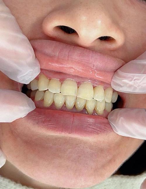 正畸牙根部位偏黄-图1