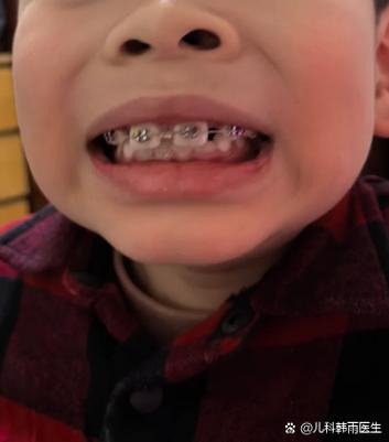 正畸牙根部位偏黄-图3