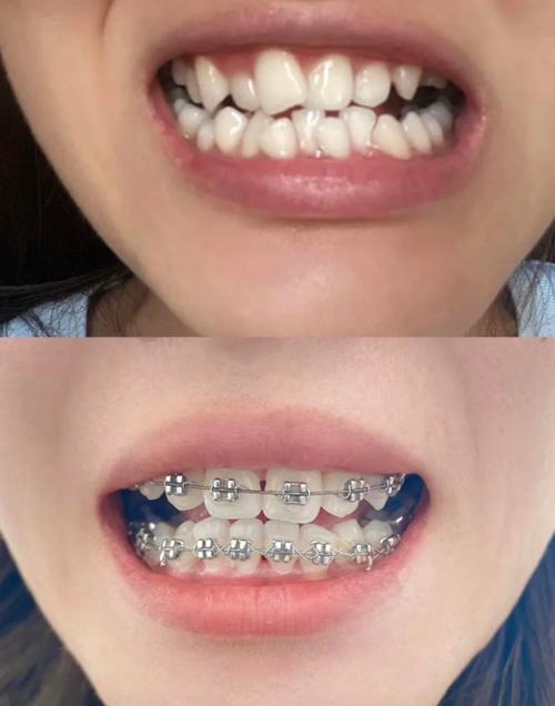 正畸牙齿出现灰线-图3