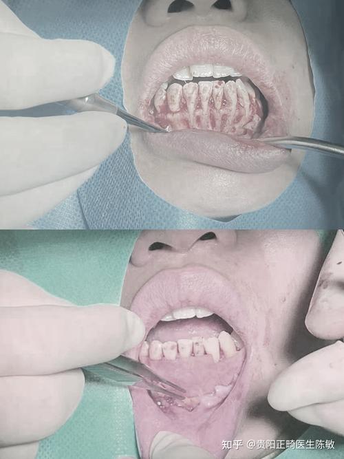 正畸下前牙骨开裂，原因是什么？如何预防与应对？-图2