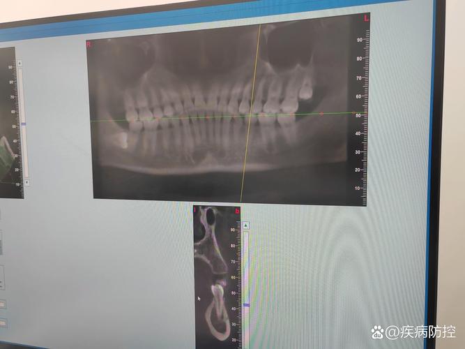 正畸下前牙骨开裂，原因是什么？如何预防与应对？-图3