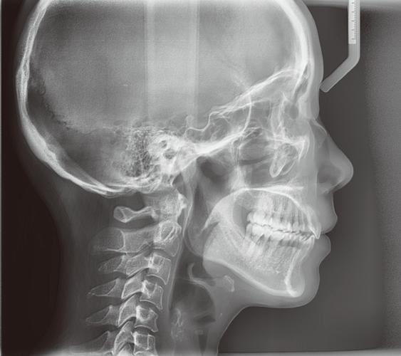 正畸头颅侧位软件-图1